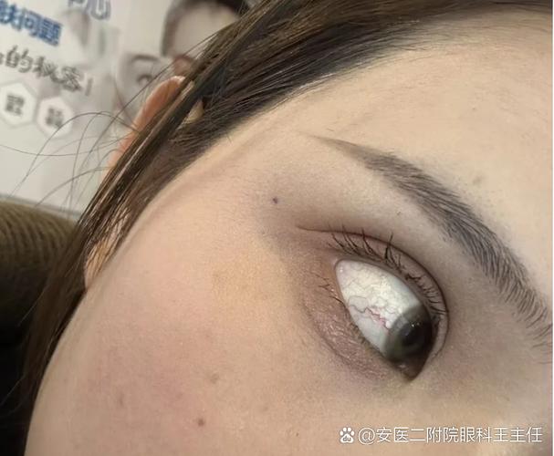 做完近视眼手术能玩手机吗